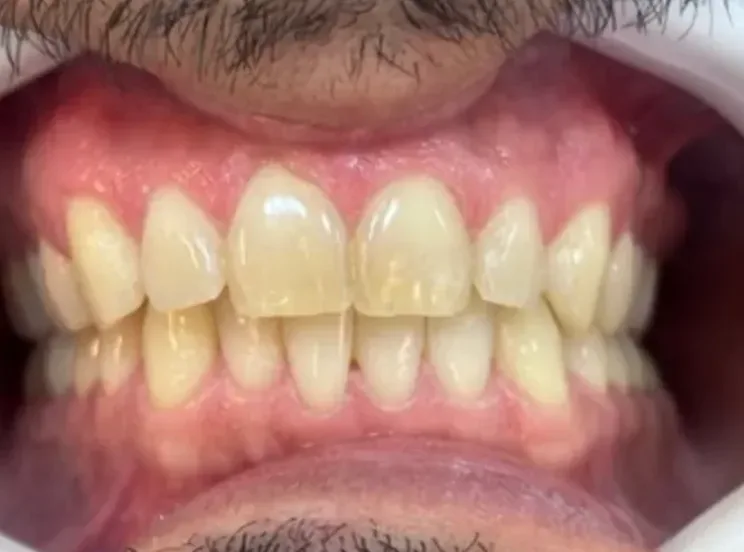 Dentes antes do clareamento, com tom amarelado