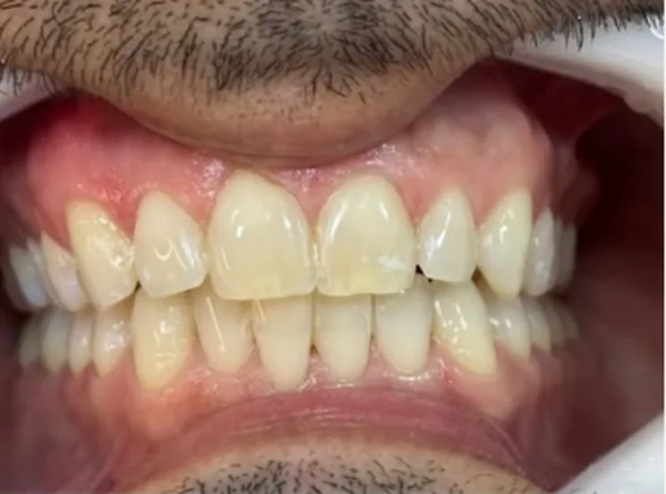 Os mesmos dentes depois do clareamento, em tom mais claro